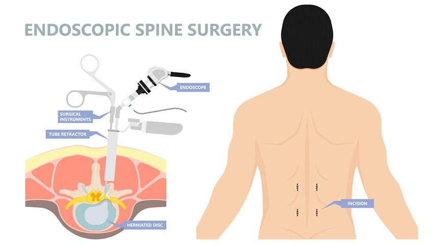 Spinal Endoscopic Surgery